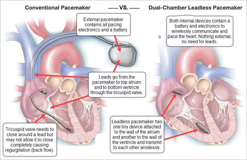 Leadless Pacemaker Anesthesia Leadless Pacemaker To Relieve Tricuspid Regurgitation | Forum ...