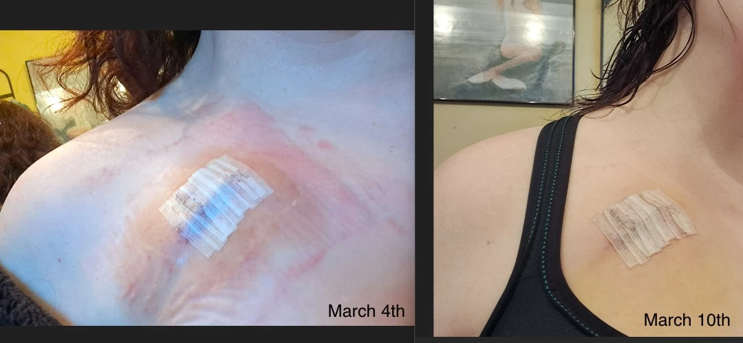 Pacemaker Club: Post op pictures